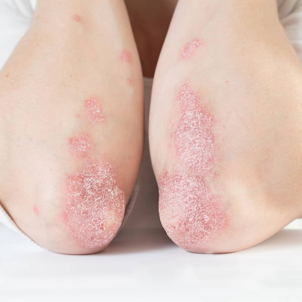 Skin Condition Psoriasis