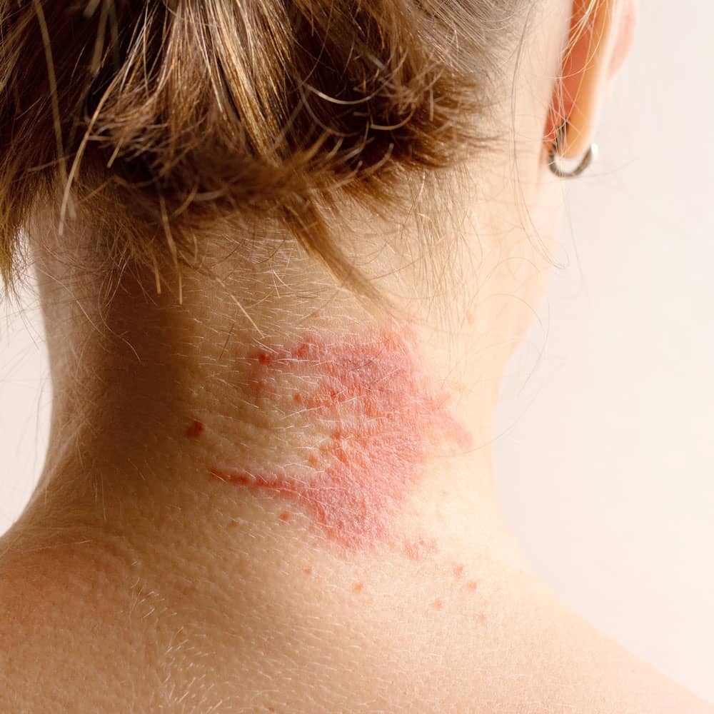 Skin Condition - Eczema